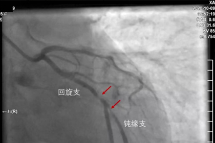 caFFR为复旦大学附属中山医院吴淞医院提供准确冠脉功能评估，引导精准介入治疗